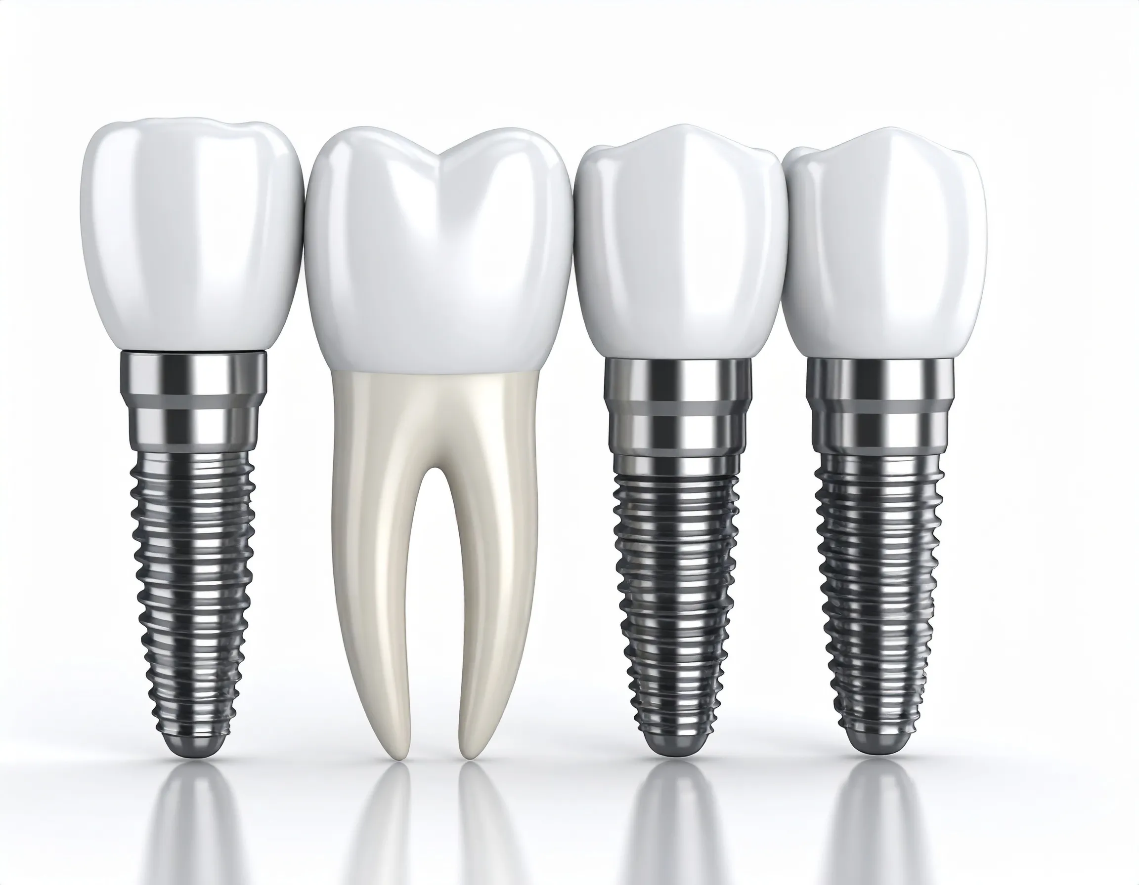 Illustration som visar 3 implantat och 1 molar placerade bredvid varandra.