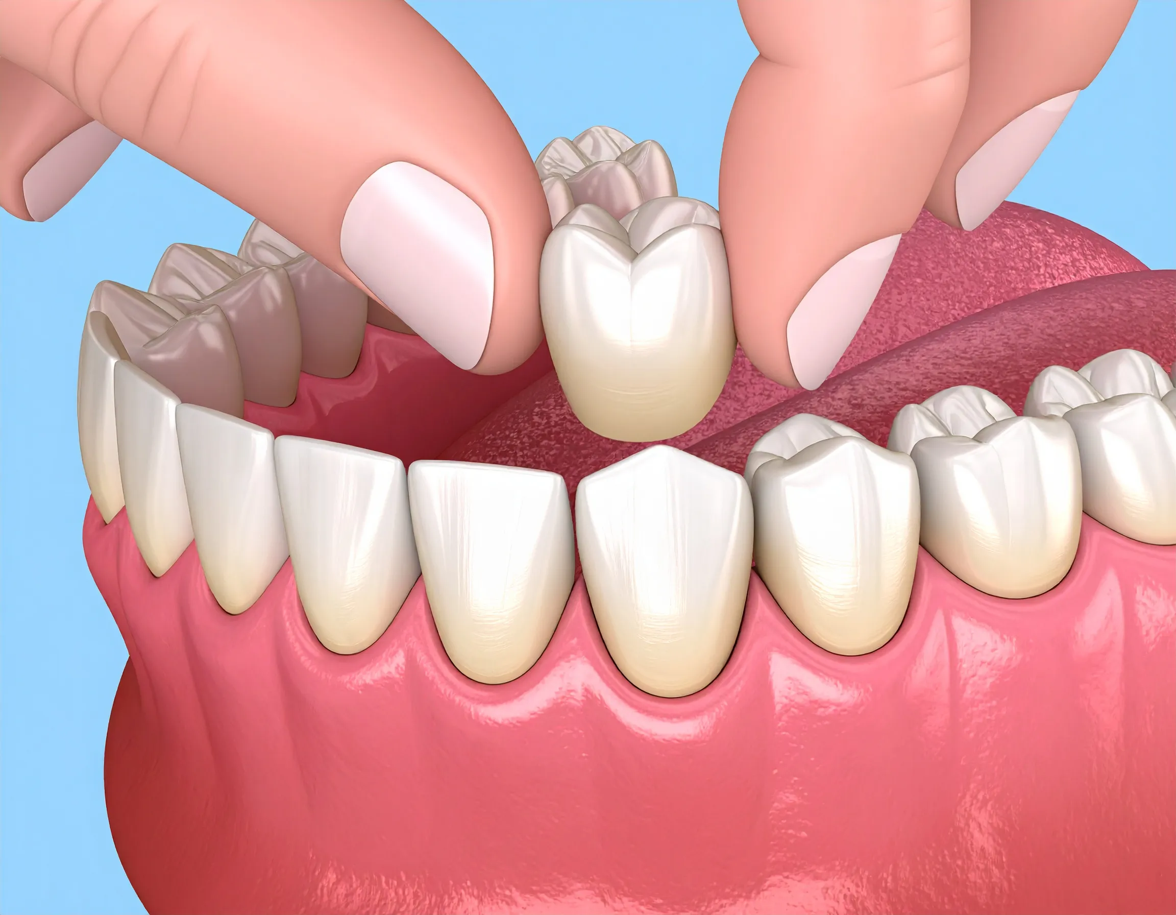 Illustration som visar en tandkrona som håller på att träs på en tand.