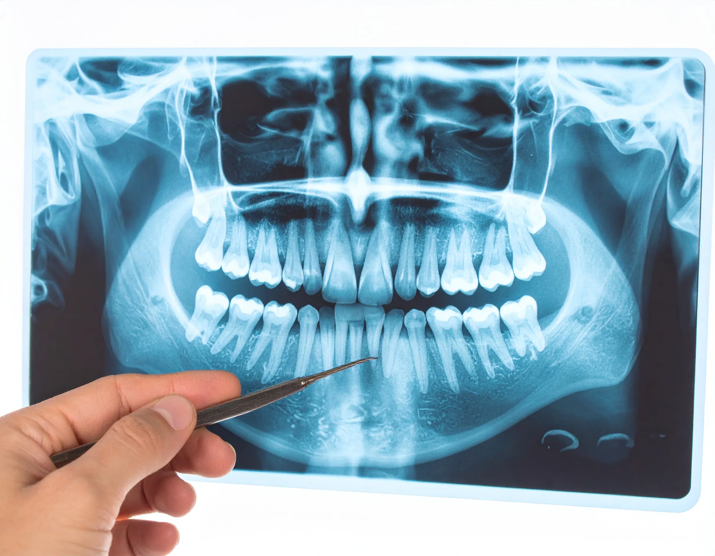 En illustration av en panorama-röntgenbild som granskas av en tandläkare.