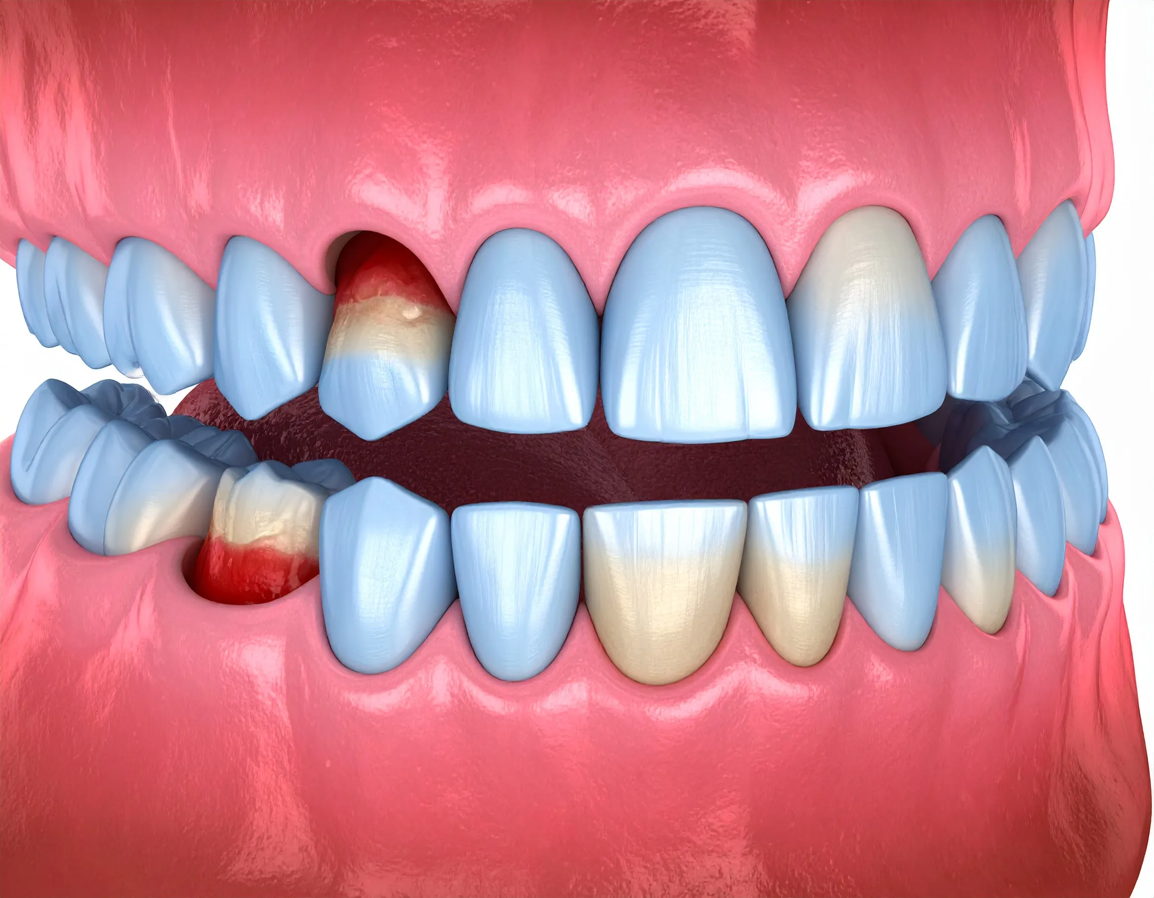 Illustration av ett inflammerat tandkött och parodontit/tandlossning.